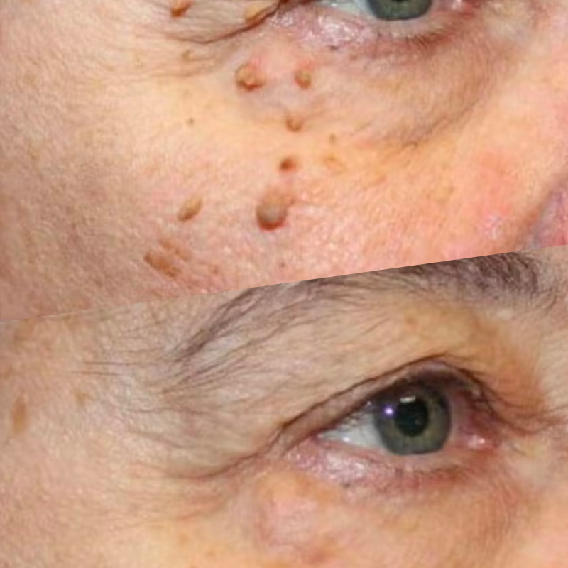 60-Minutes Skin-Tag Removal Session 60-Minutes Skin-Tag Removal Session